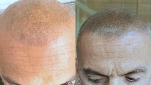 Tricopigmentazone post trapianto di capelli a Macerata