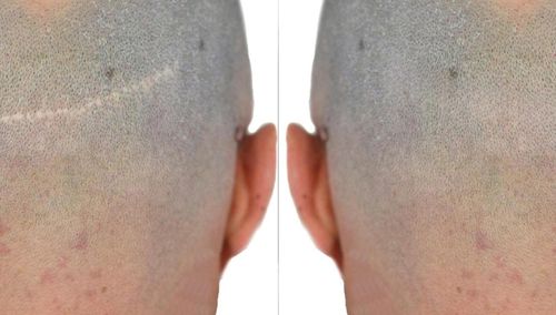 COPERTURA CICATRICE POST TRAPIANT fut fue CON LA TRICOPIGMENTAZIONE A MACERATA