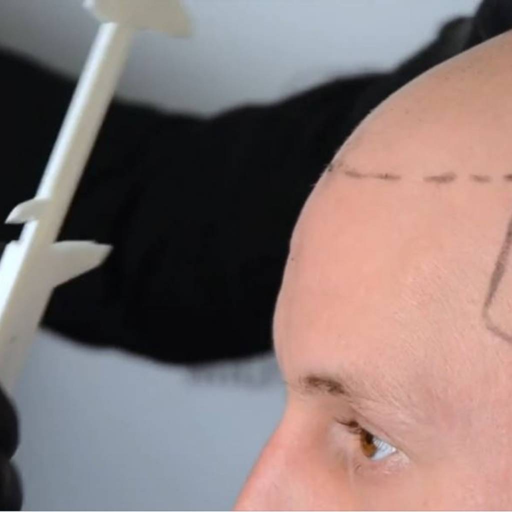 Mappatura e prova colore per tricopigmentazione del cuoio capelluto