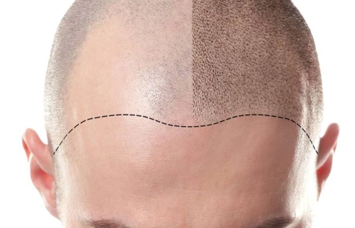 Come Funziona la Tricopigmentazione Procedura di tricopigmentazione con effetto rasato naturale su cuoio capelluto soluzione calvizie Ancona soluzione calvizie Pesaro e Fano, soluzione calvizie Ascoli e San Benedetto del Tronto, soluzioni calvizie Macerata, soluzione calvizie Fermo e Porto San Giorgio