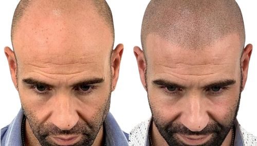 Tricopigmentazione effetto rasato