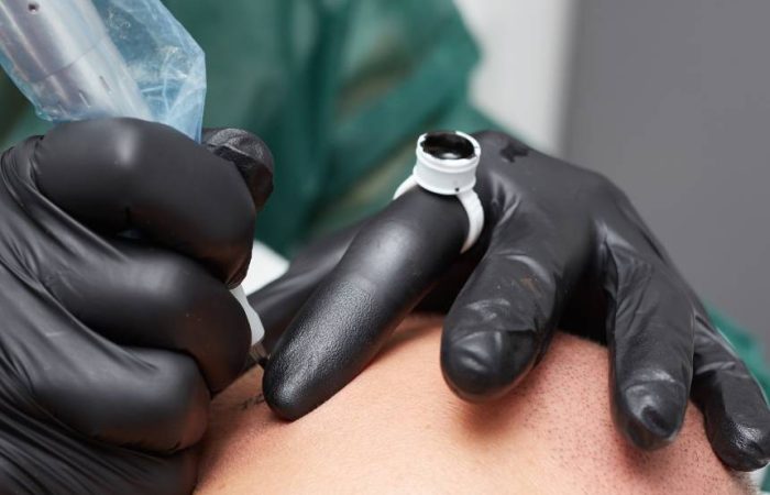 cos’è la tricopigmentazione Esempio di tricopigmentazione effetto rasato eseguita presso FM Tricopigmentazione Macerata